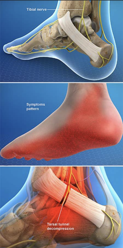 Flexor Retinaculum Of The Foot Retinacula Injuries And Treatment Dr Justin Dean