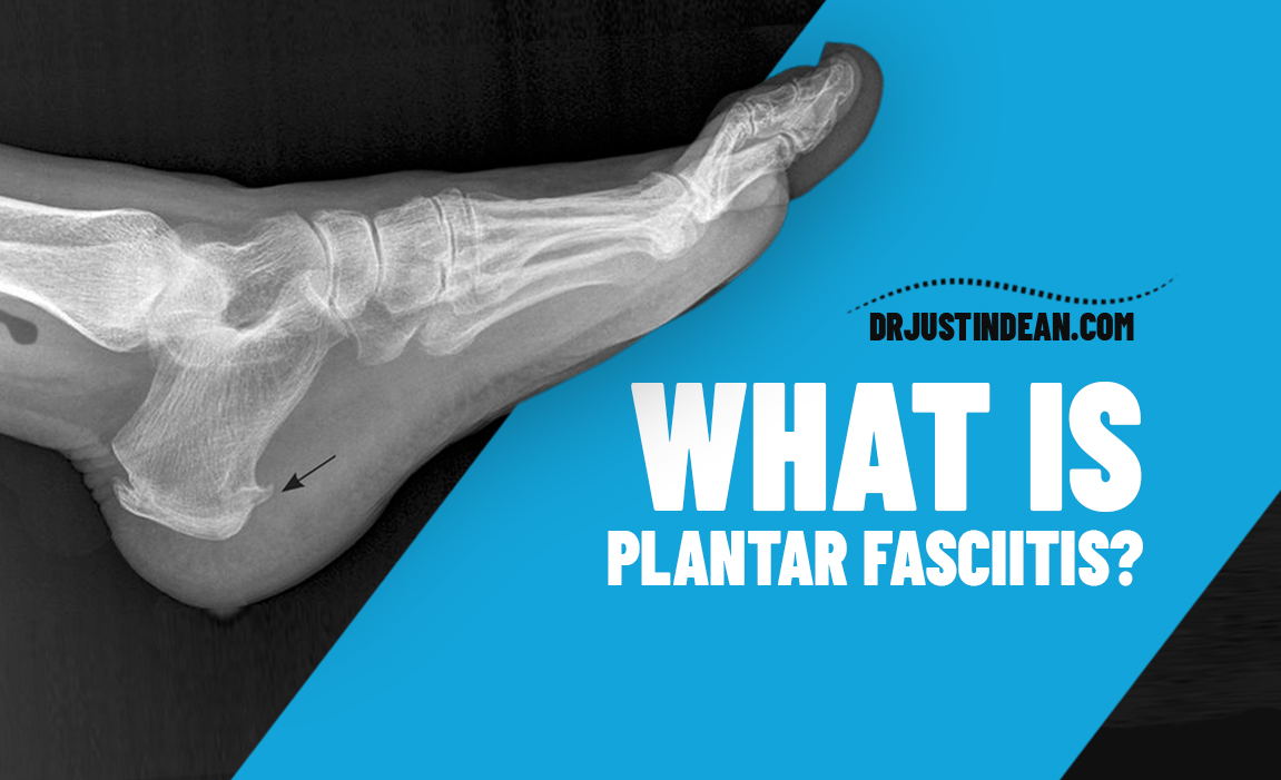 What Is Plantar Fasciitis Is It From A Bone Spur In The Foot Dr