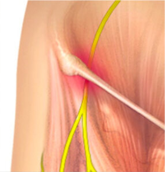 Meralgia Paresthetica: Causes, Symptoms & Treatment