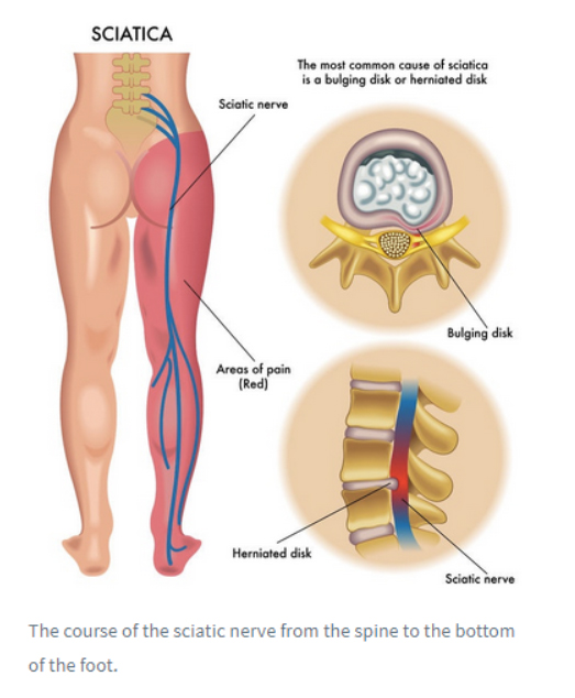 Is It Really SCIATICA? — Indy Spine and Rehab