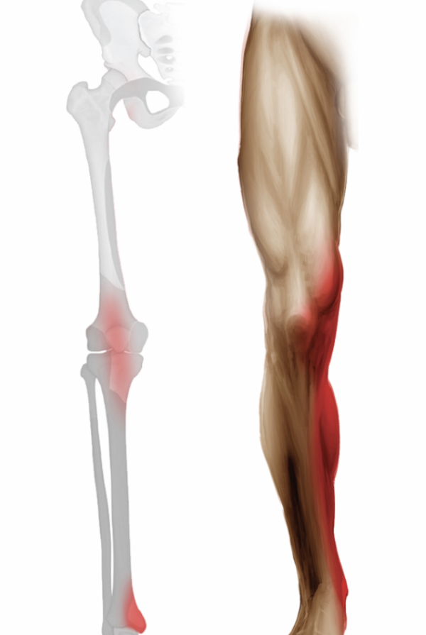 Runner's Knee Treatment Dr. Justin Dean