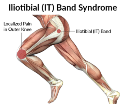 Runner's Knee Treatment - Dr. Justin Dean