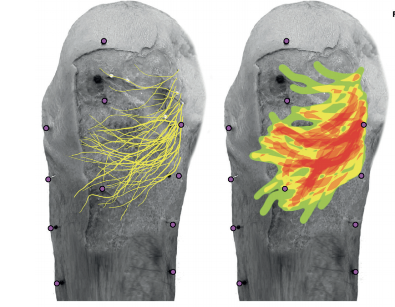 Saphenous Nerve Entrapment Dr Justin Dean Saphenous Nerve Entrapment Dr Justin Dean