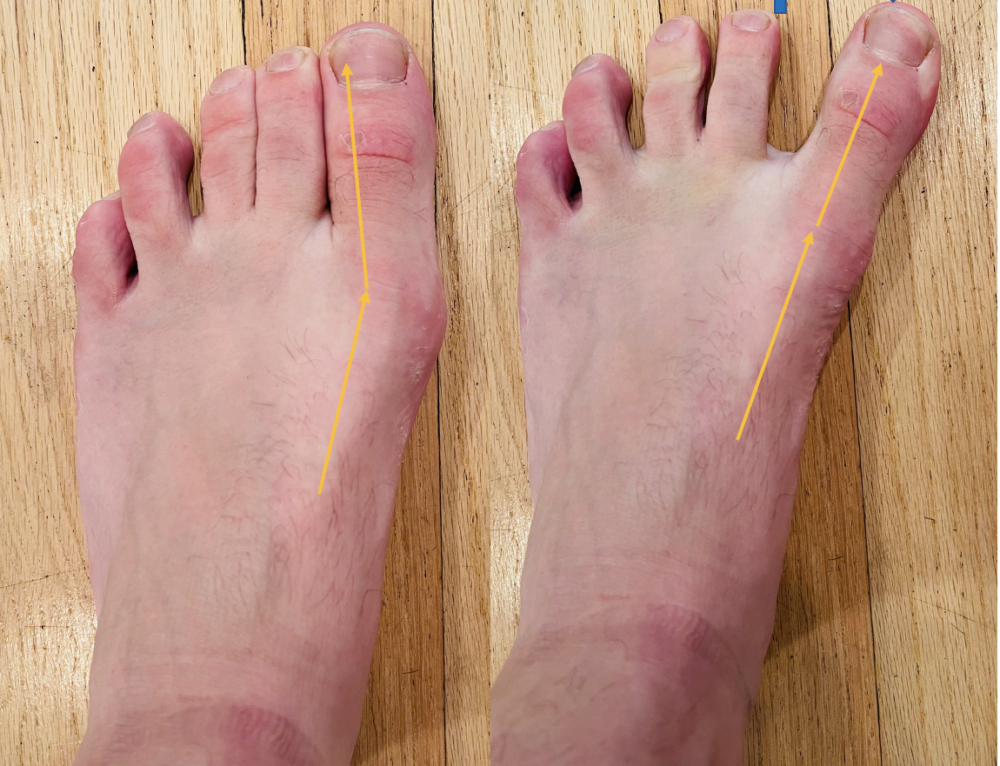 Adductor Hallucis: Weakness Causes Painful toes, Arch and Creates