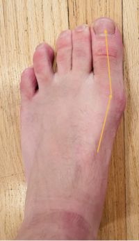 Adductor Hallucis: Weakness Causes Painful toes, Arch and Creates ...