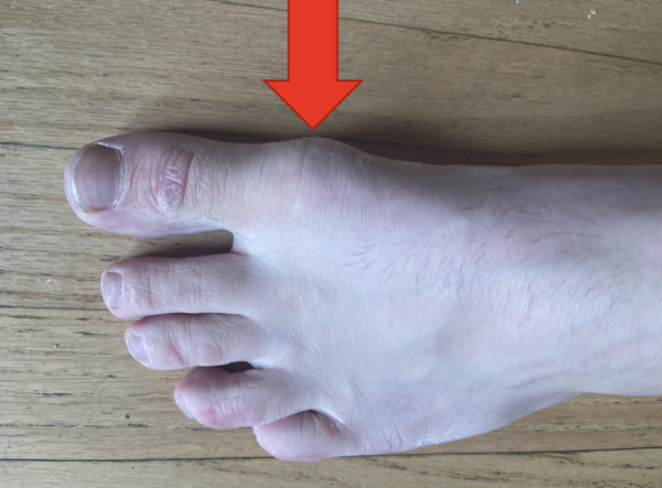 big-toe-pain-5-causes-of-a-painful-big-toe-dr-justin-dean