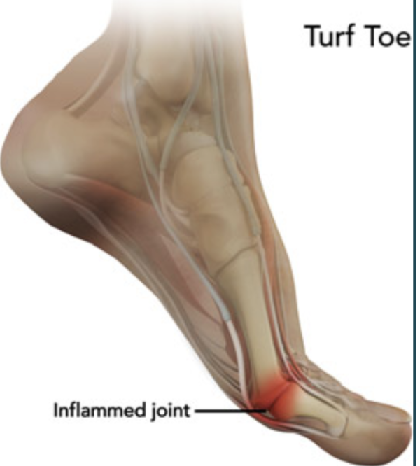 Big Toe Pain 5 Causes of a Painful Big Toe Dr. Justin Dean