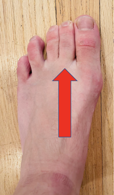 second-toe-pain-capsulitis-of-the-second-toe-dr-justin-dean