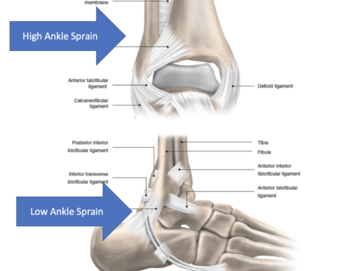 High Ankle Sprain: Sprained Ankle (Syndesmotic)