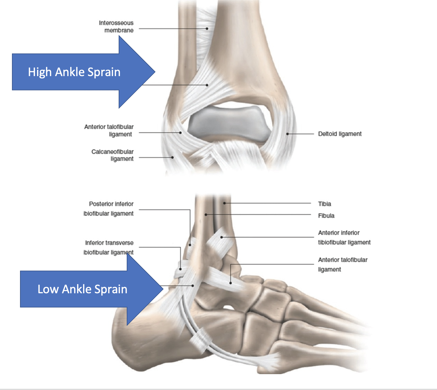 Interosseous Membrane Ankle Tear