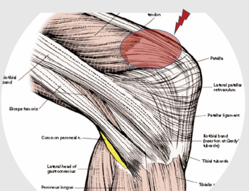 Quadriceps Tendonitis: Knee Tendonitis