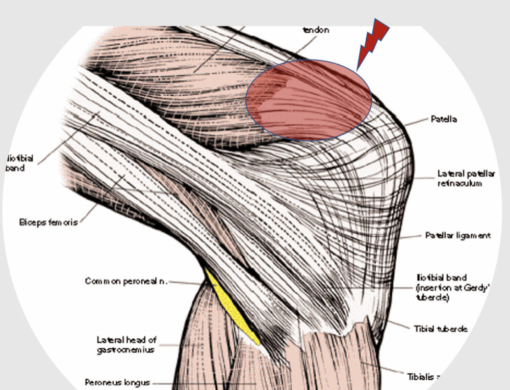 Pes Anserine bursitis: Knee Pain