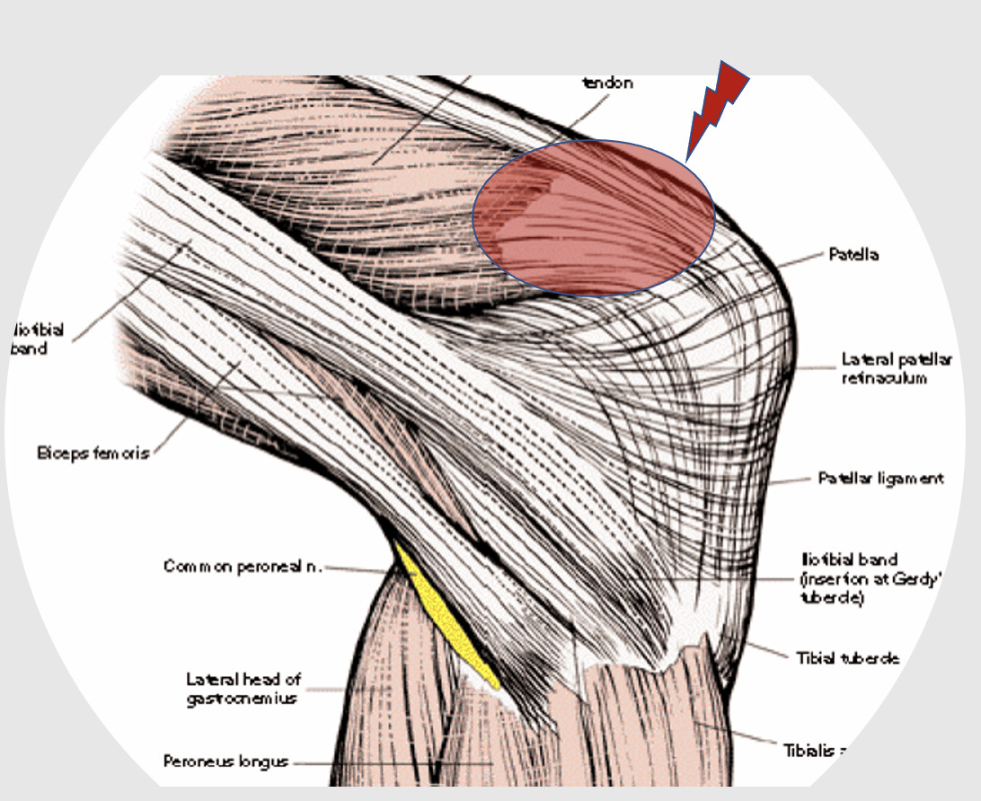 kneecap muscle pain