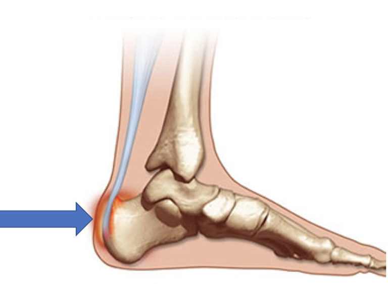 Retrocalcaneal Bursitis: Achilles Bursitis - Dr. Justin Dean