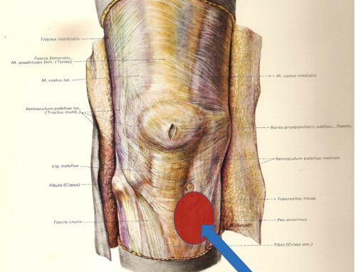 Pes Anserine bursitis: Knee Pain