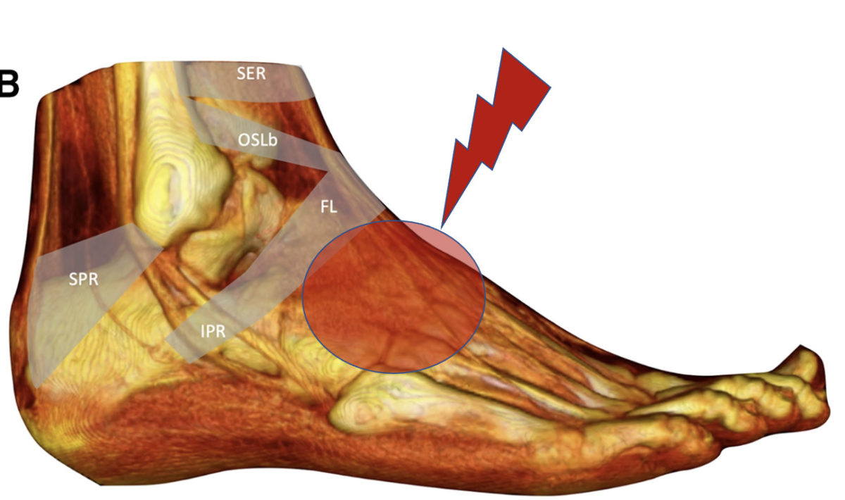 extensor-tendonitis-foot-tendonitis-explained-dr-justin-dean