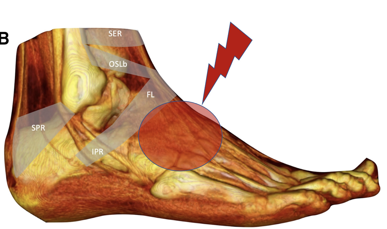 Extensor Tendonitis Foot Tendonitis Explained Dr Justin Dean