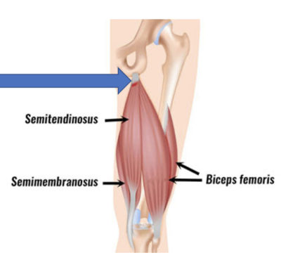 Hamstring Tendonitis: Hamstring Tendinopathy - Dr. Justin Dean