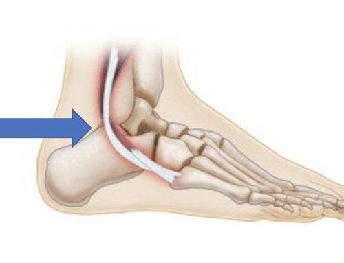 Peroneal Tendon Tear: Foot and Ankle Injuries