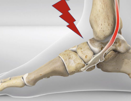 Front of Ankle Pain: Anterior Ankle Impingement