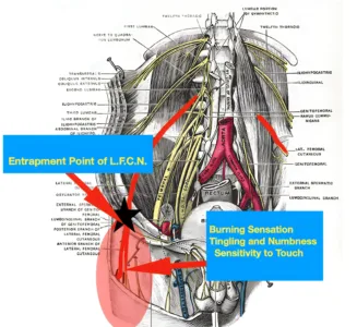 Picture showing anatomy of the lateral femoral cutaneous nerve. Includes entrapment points and symptom location