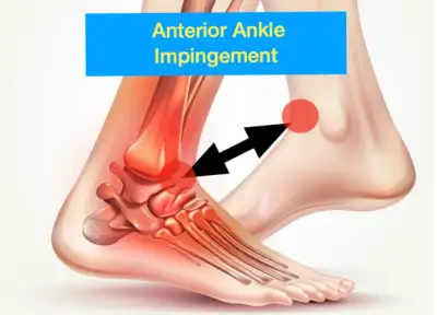 A picture of two feet and ankles showing the location and pain distribution of anterior ankle impingement
