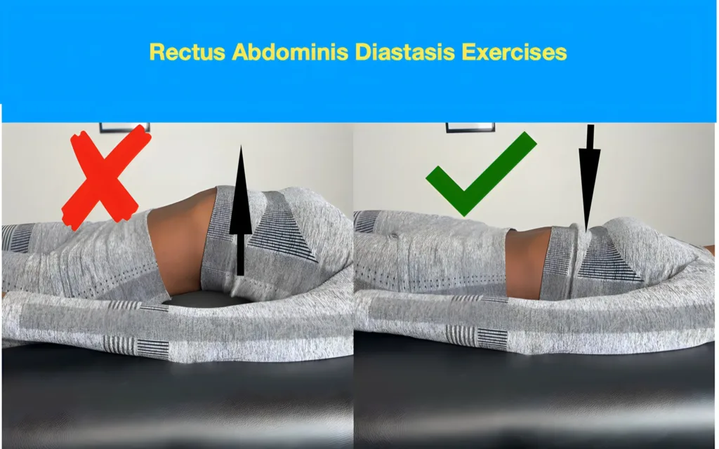 A picture showing the importance of rib position during exercises for Diastasis recti