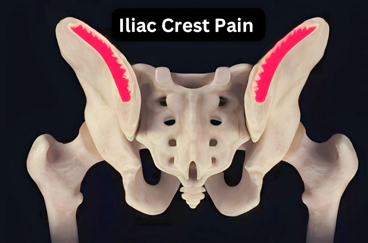 Bones of the pelvis with a shaded red area indicating where people have pain over the iliac crest