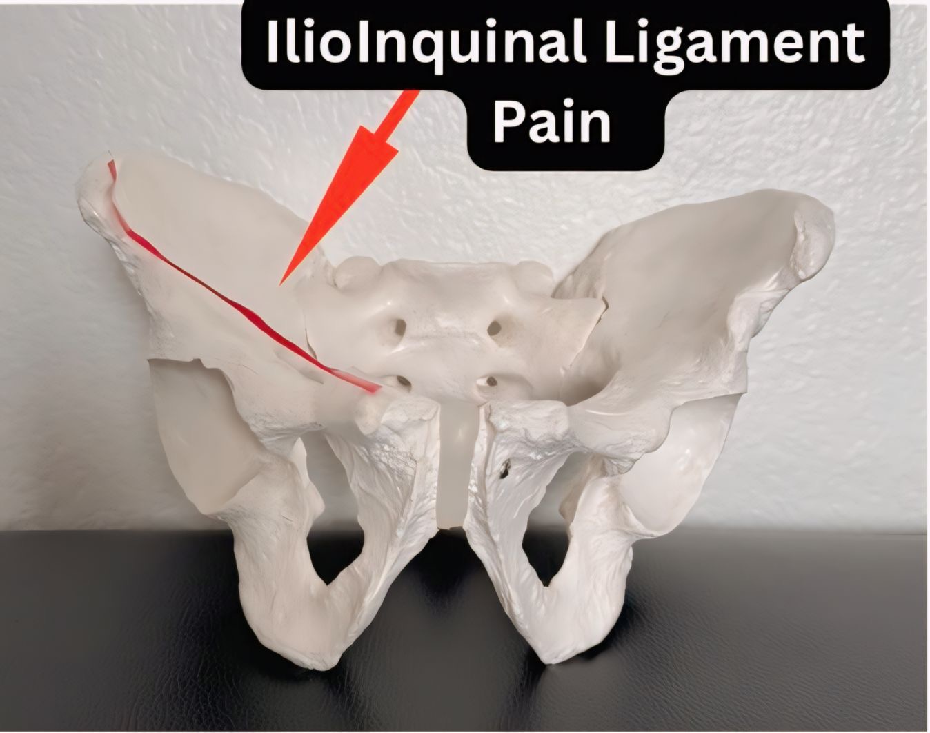 A model depicting the location of the ilioinquinal ligament