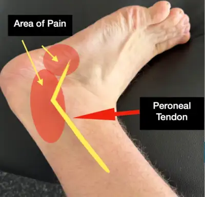 A picture showing a peroneal tendon dislocation sites and where it would cause pain