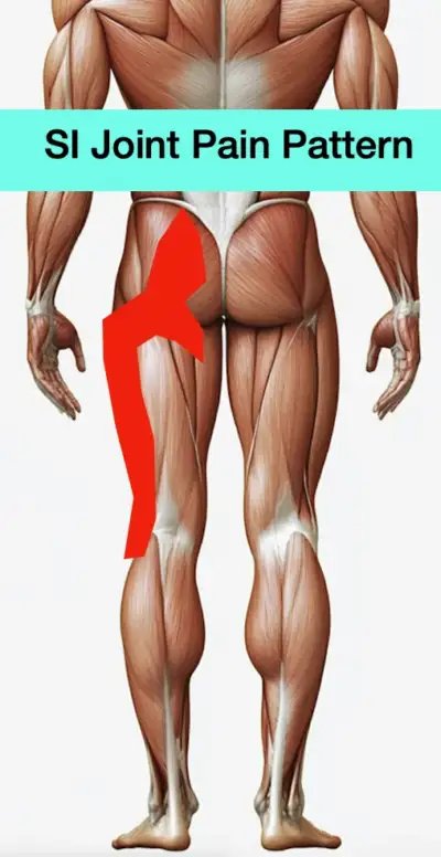 an image depicting research supported pain referral patterns of SI joint dysfunction